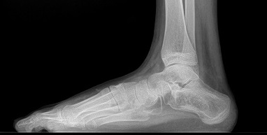 Flat Foot Surgery In Children And Adults - Pediatric Foot Surgery in NYC