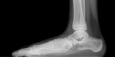 Flexible Flatfoot Treatment in Children