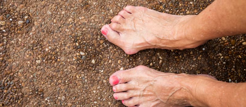 The Consequences of Hammertoe